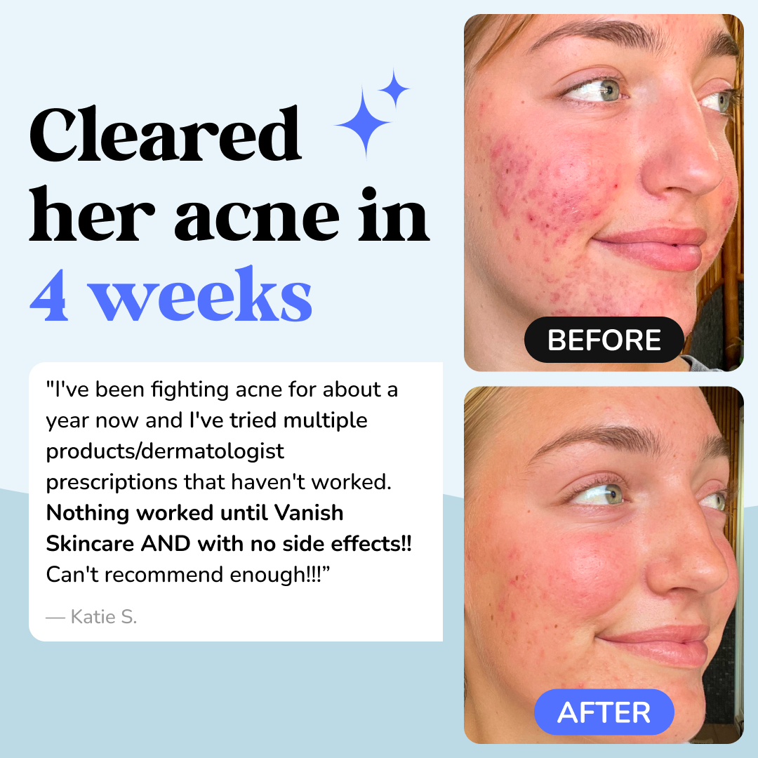 DrySerum™ Acne Clearing & Skin Healing Regimen