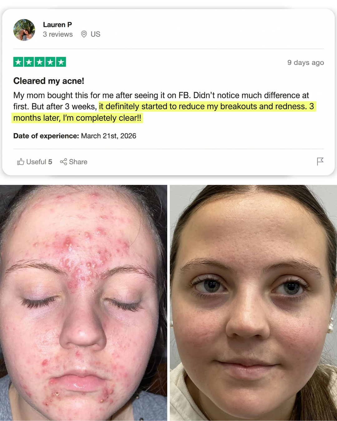 Teen Acne Clearing & Skin Healing Regimen