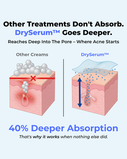 The Acne Vanishing System For Teens