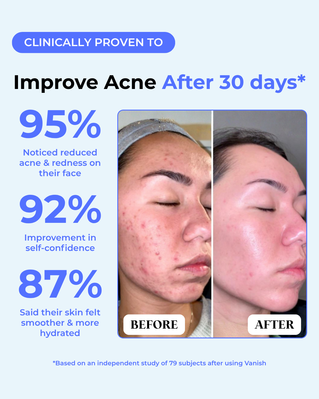 Teen Acne Clearing & Skin Healing Regimen