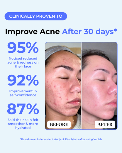 The Acne Vanishing System For Teens