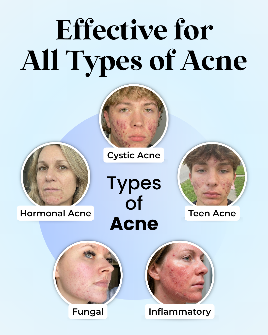 Vanish DrySerum™ effective for all acne types: cystic, hormonal, teen, fungal and inflammatory — real customer photos
