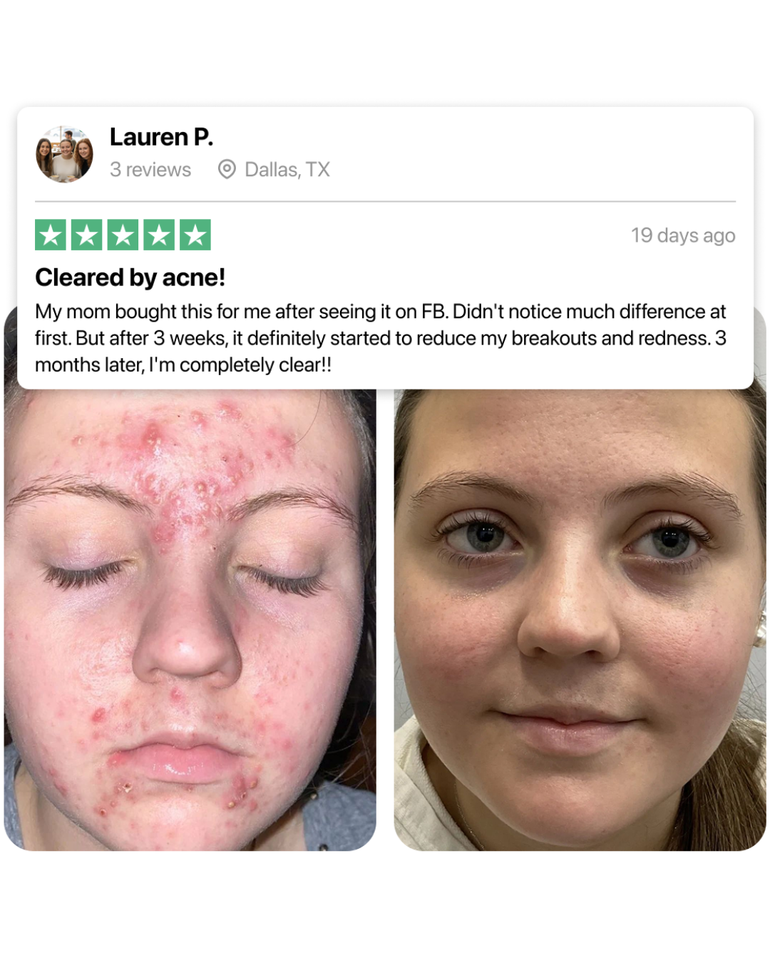 DrySerum™ Teen Acne Kit