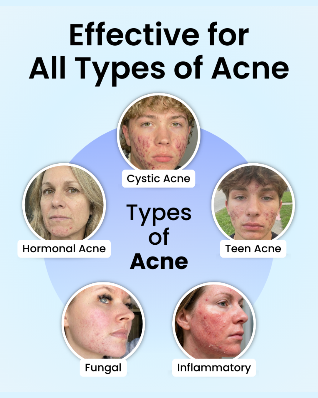 DrySerum™ Teen Acne Kit