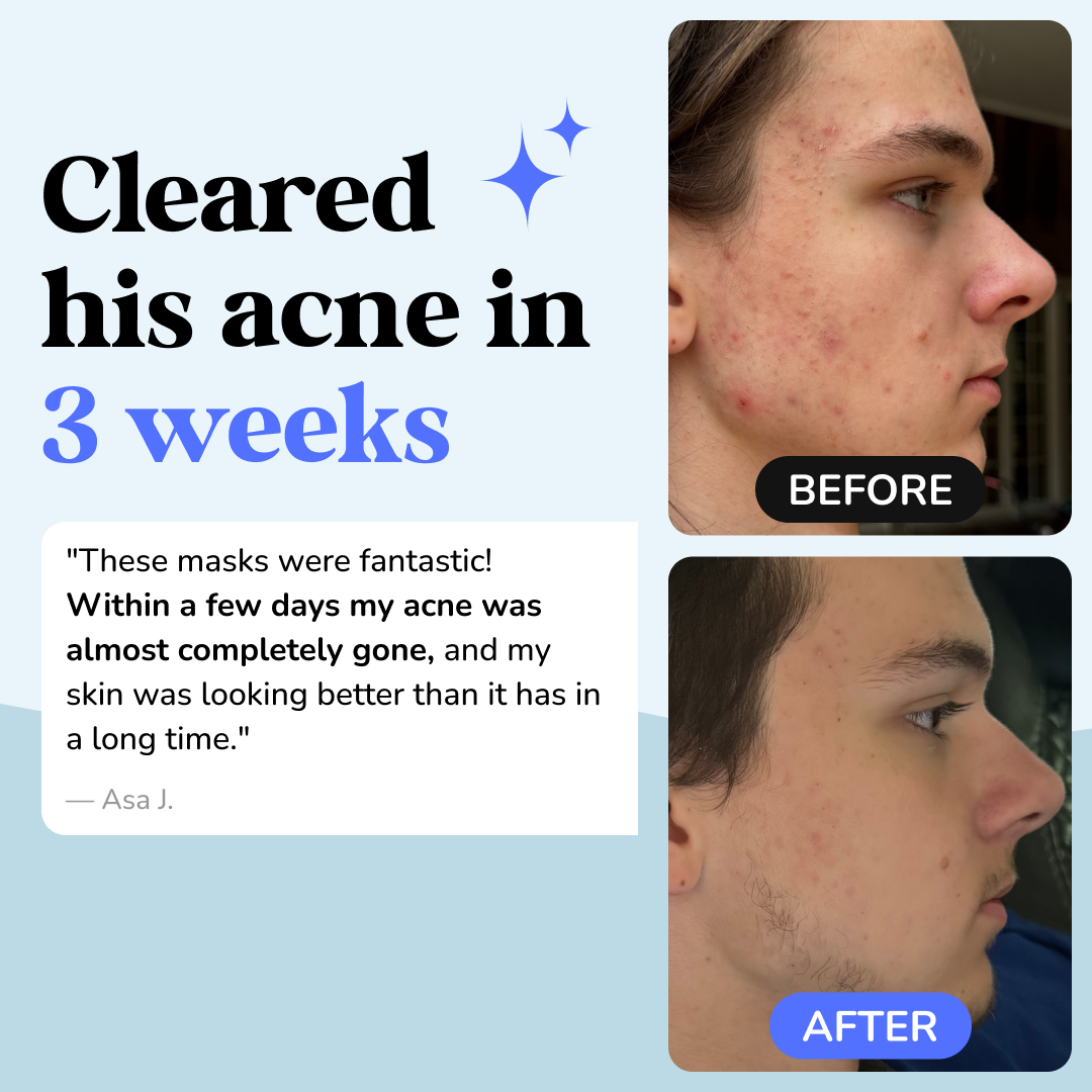DrySerum™ Acne Clearing & Skin Healing Regimen