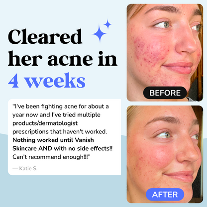 DrySerum™ Acne Clearing & Skin Healing Regimen