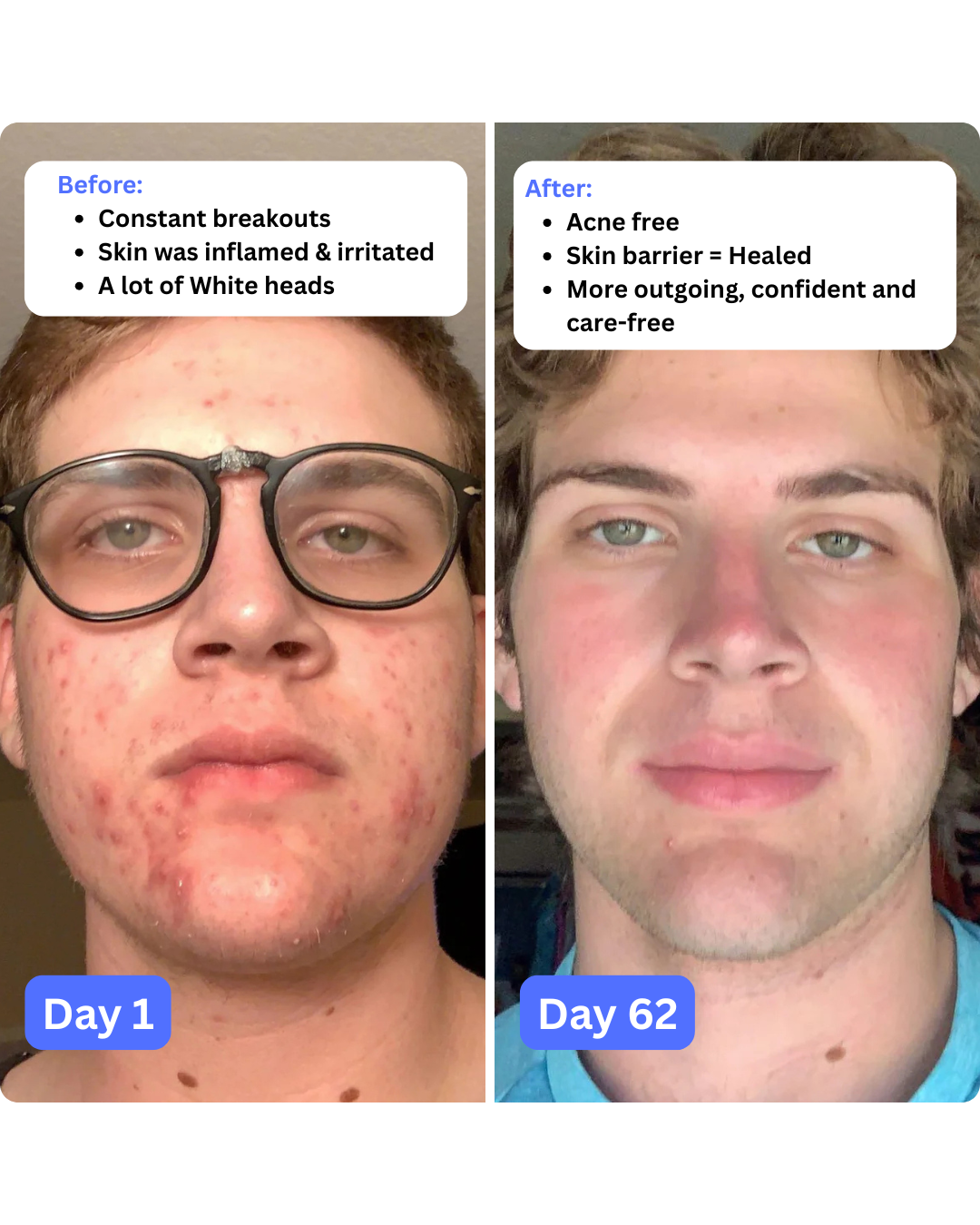 DrySerum™ Teen Acne Kit