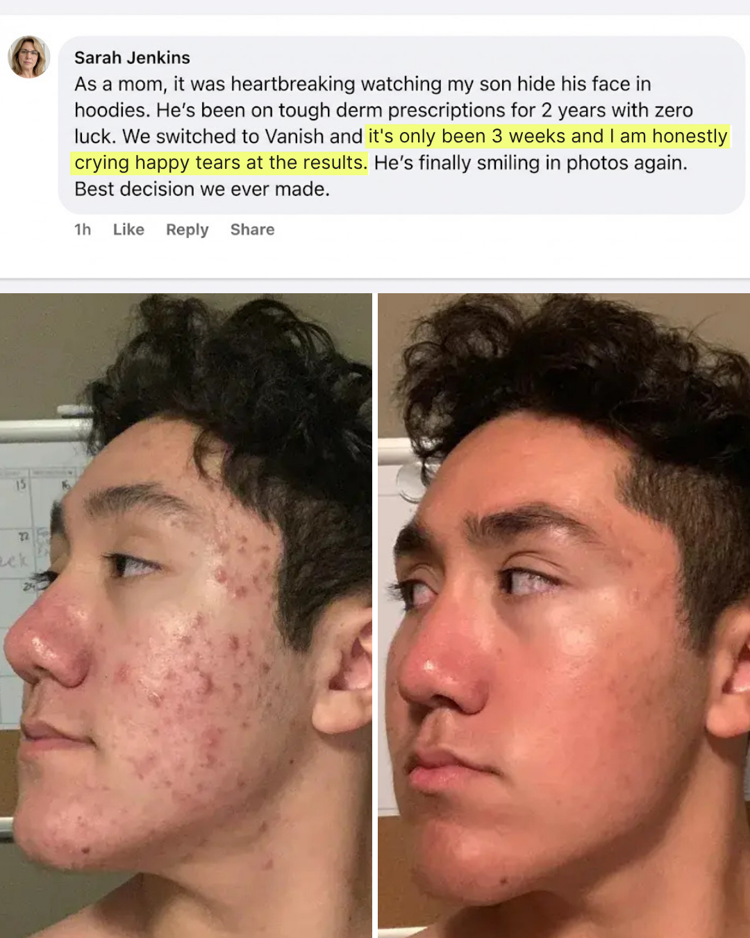 Teen Acne Clearing & Skin Healing Regimen