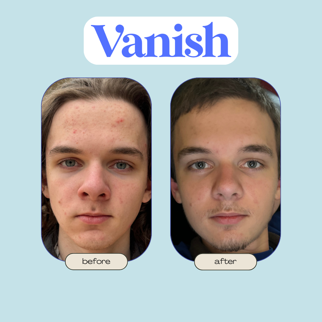 Vanish™ Acne DrySerum™ Masks (30 Day Routine)