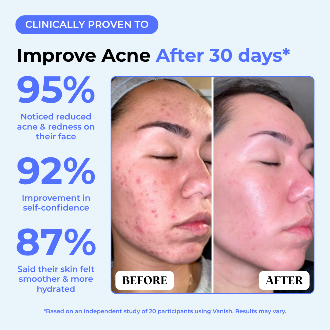 Clinically proven before and after: 95% reduced acne and redness, 92% improved confidence after 30 days on Vanish DrySerum™