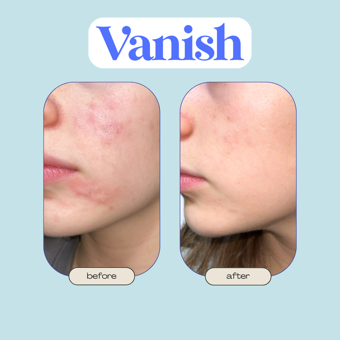 Vanish™ Acne DrySerum™ Masks (30 Day Routine)