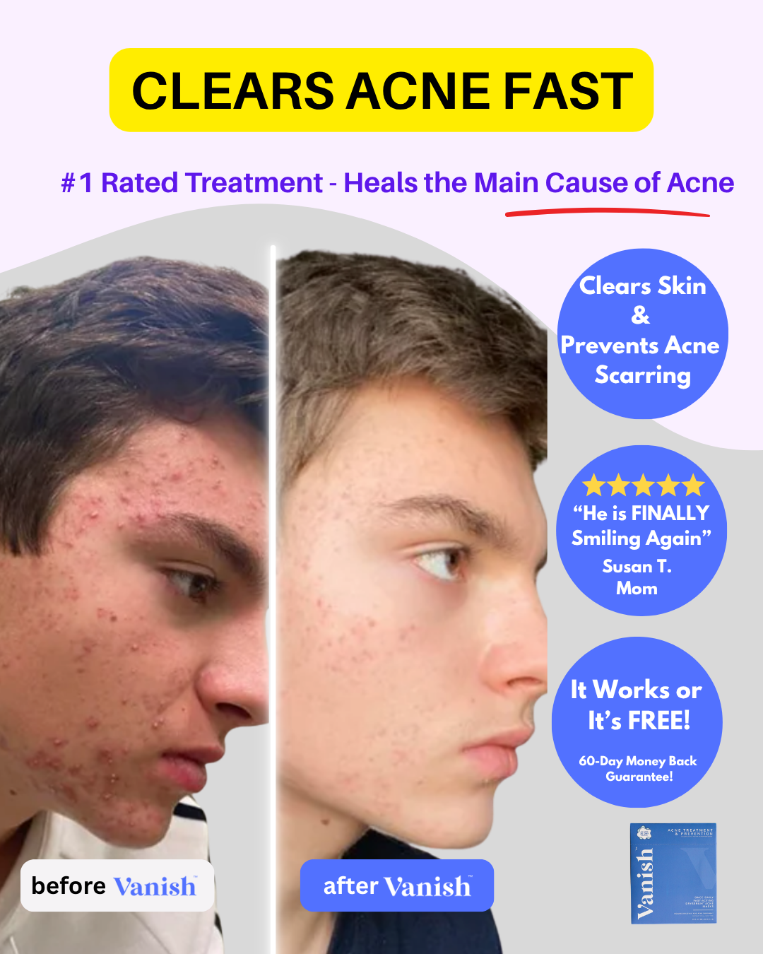 DrySerum™ Teen Acne Kit