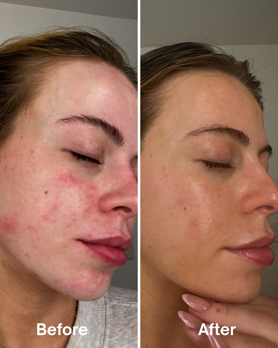 DrySerum™ Teen Acne Kit
