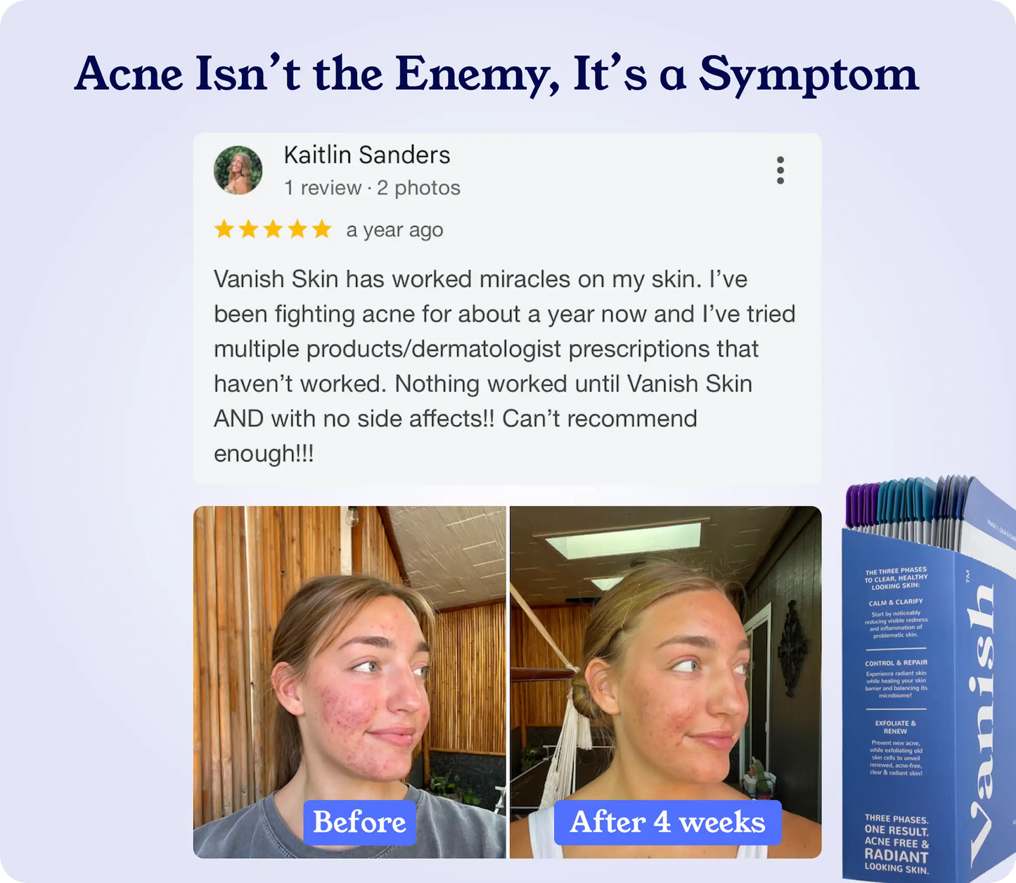 Clear Acne, Heal Skin & Prevent Acne Scars