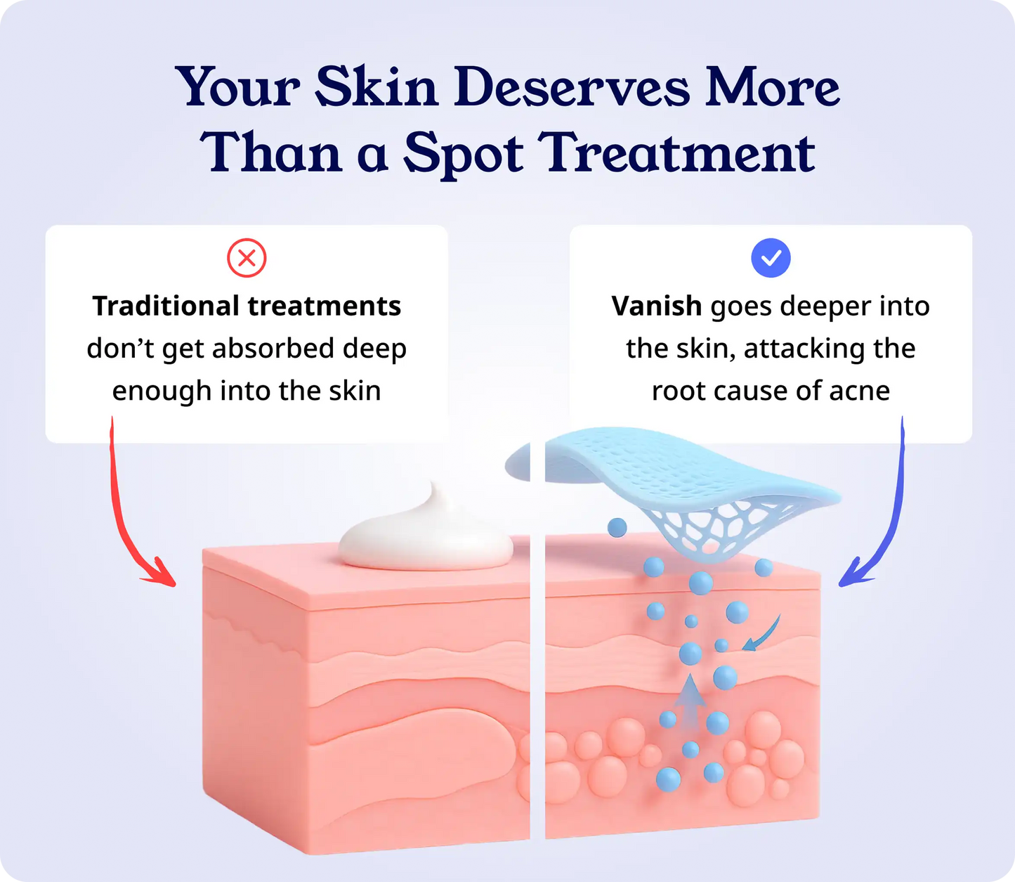 Clear Acne, Heal Skin & Prevent Acne Scars