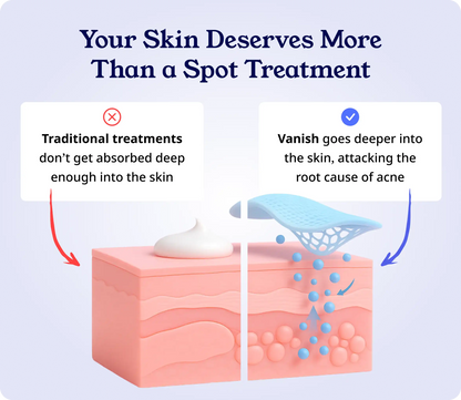 Clear Acne, Heal Skin & Prevent Acne Scars