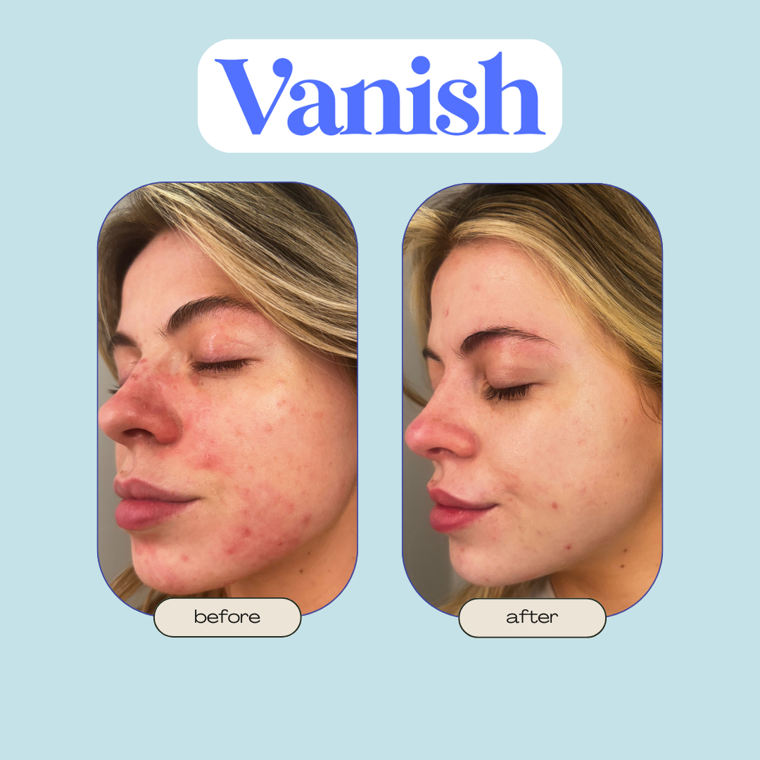 Vanish™ Acne DrySerum™ Masks (30 Day Routine)