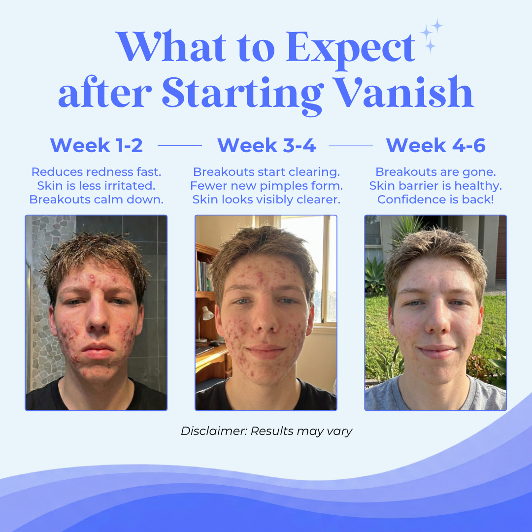 Vanish DrySerum™ results timeline: Week 1-2 redness reduces, Week 3-4 breakouts clear, Week 4-6 skin fully clear — teen male