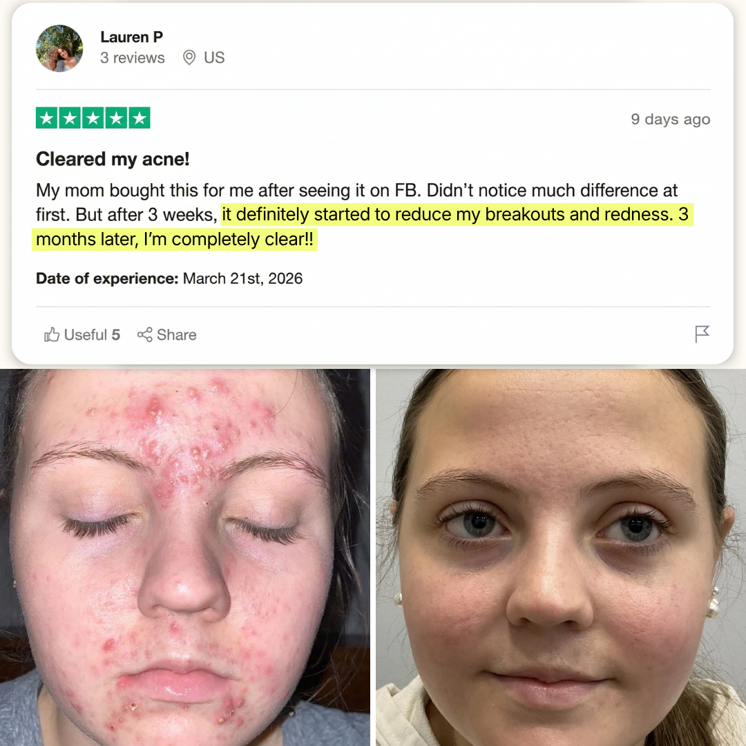 Lauren P. before and after showing severe forehead acne fully cleared after 3 months on Vanish DrySerum