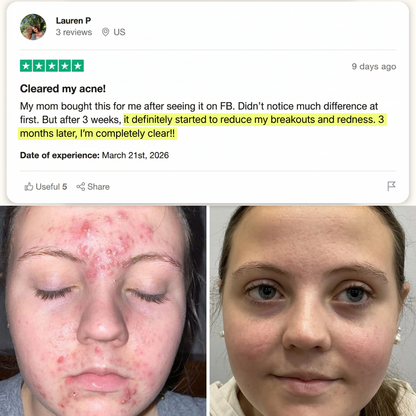 The Acne Vanishing System For Teens