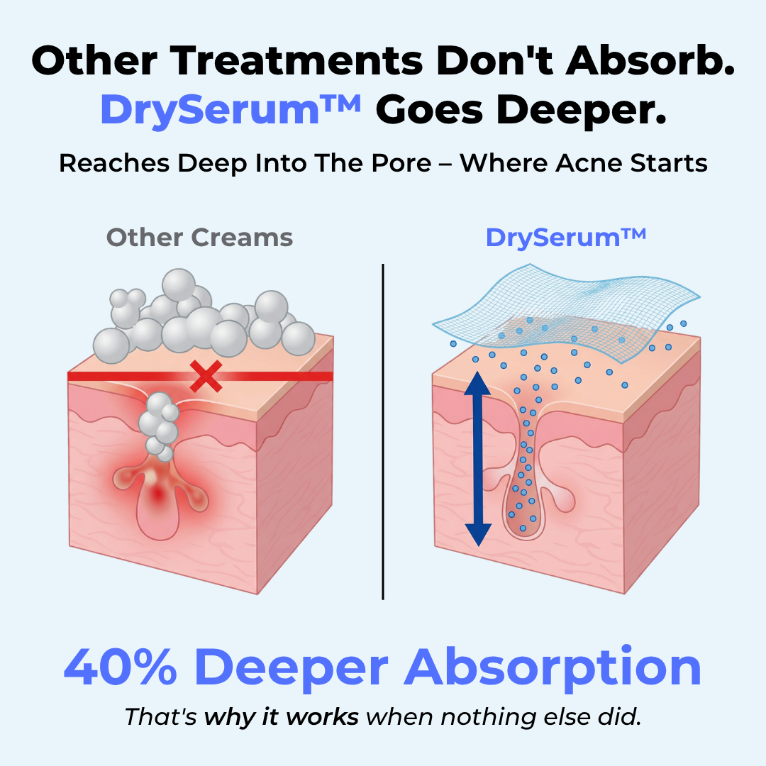 Diagram comparing DrySerum™ vs other creams: DrySerum™ absorbs 40% deeper into pores where acne starts, other creams don't penetrate