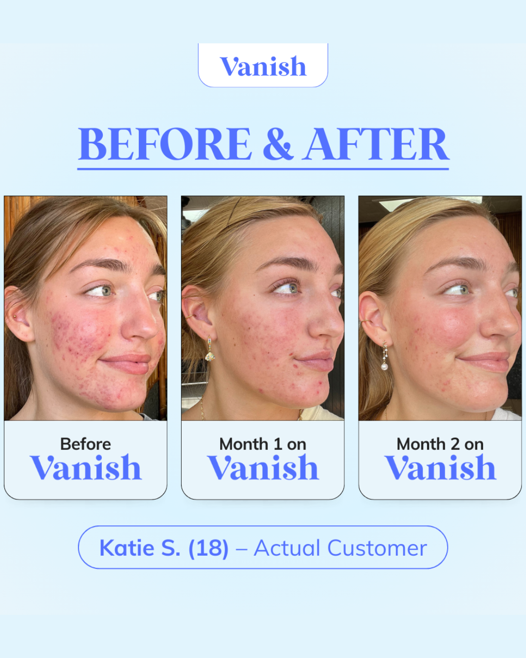 The Acne Vanishing System For Teens