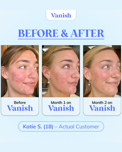 The Acne Vanishing System For Teens