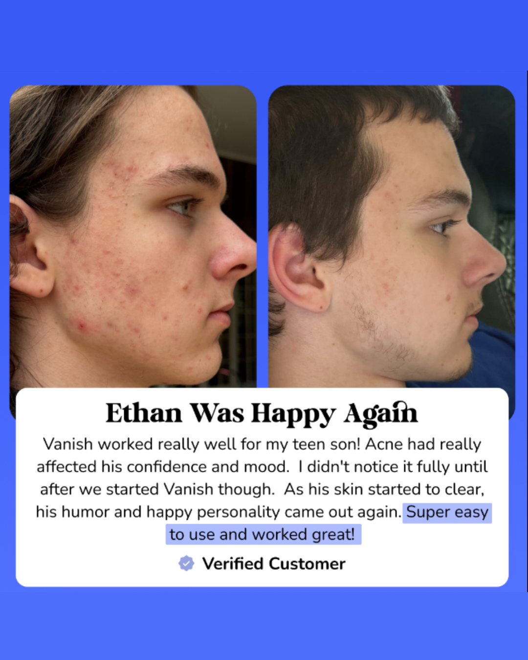 DrySerum™ Teen Acne Kit