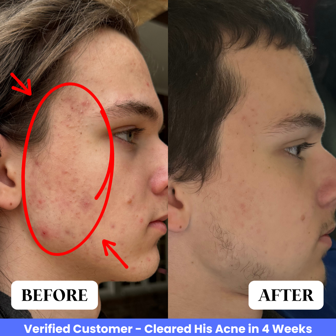 Verified customer before and after 4 weeks: teenage male's cheek and forehead acne fully cleared using Vanish DrySerum™ Regimen